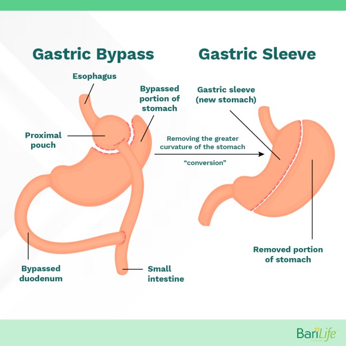 Can i take antihistamine after gastric sleeve