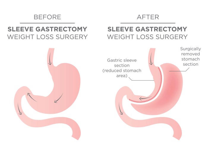 Can i take antihistamine after gastric sleeve